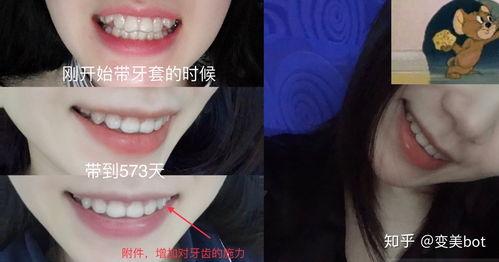 国产牙套外形视频